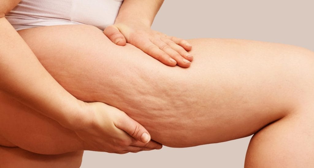 woman showing her legs with cellulite 1 1024x549