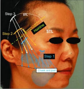 The Journal - thread lifts, explained by a plastic surgeon images